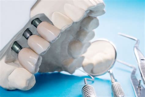  Metaloceramica: Materiale Innovativo per Impianti Dentali e Protesi Osseo-Integrative!